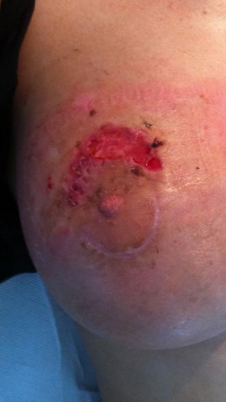 la 2 saptamani dupa a doua operatie