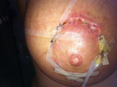 la 3 sapt dupa prima operatie