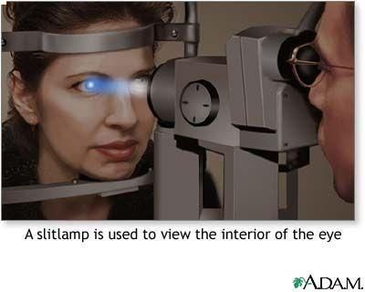LASER ZEISS VISULAS  YAG III
