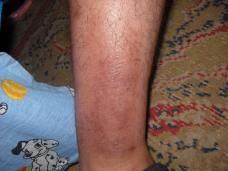 mancarime piele pe gamba piciorului