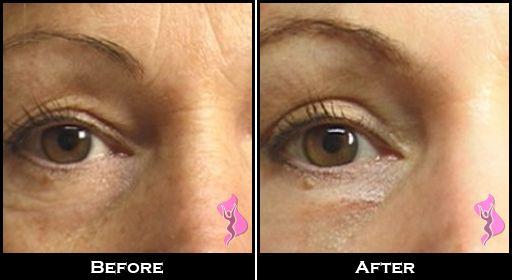 Blefaroplastie