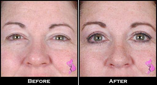 Blefaroplastie