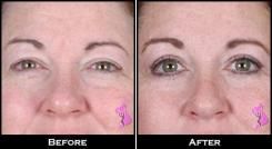 Blefaroplastie