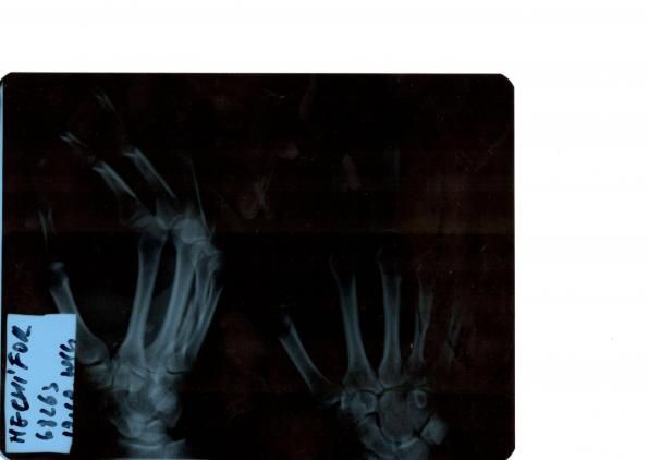 Fractura diafiza