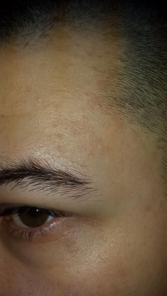 Pete pe corp care se cojesc