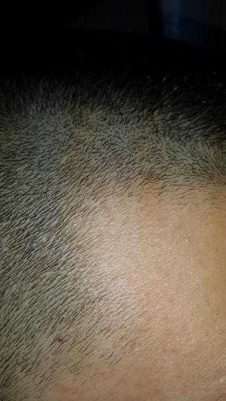 Pete pe corp care se cojesc 2