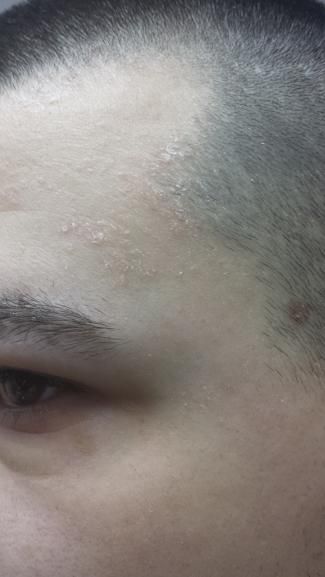 Pete pe corp care se cojesc 3