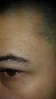 Pete pe corp care se cojesc