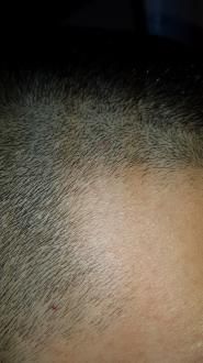 Pete pe corp care se cojesc 2