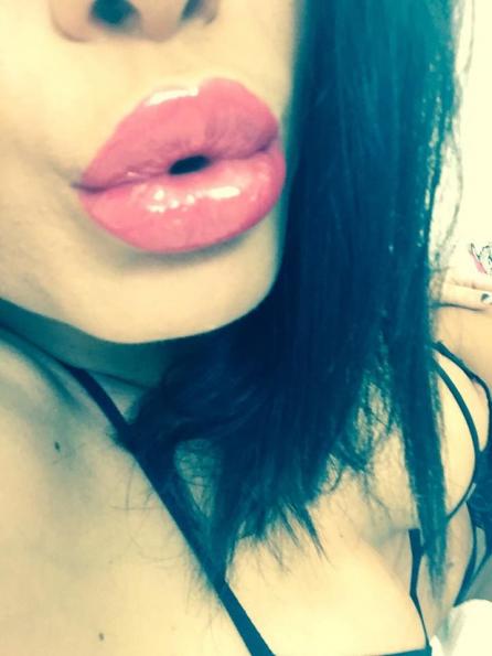 Marire buze cu acid hialuronic Princess