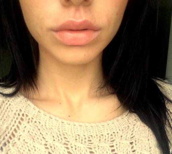 Marire buze cu acid hialuronic Princess Bucuresti