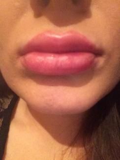 Marire buze cu acid hialuronic Princess